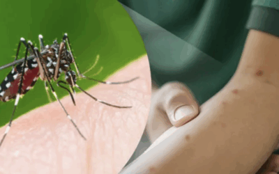 Suhu Meningkat, Kematian DBD Ikut Naik: Riset Dosen FKM UNEJ Ungkap Hubungan Kritis Perubahan Iklim di Indonesia