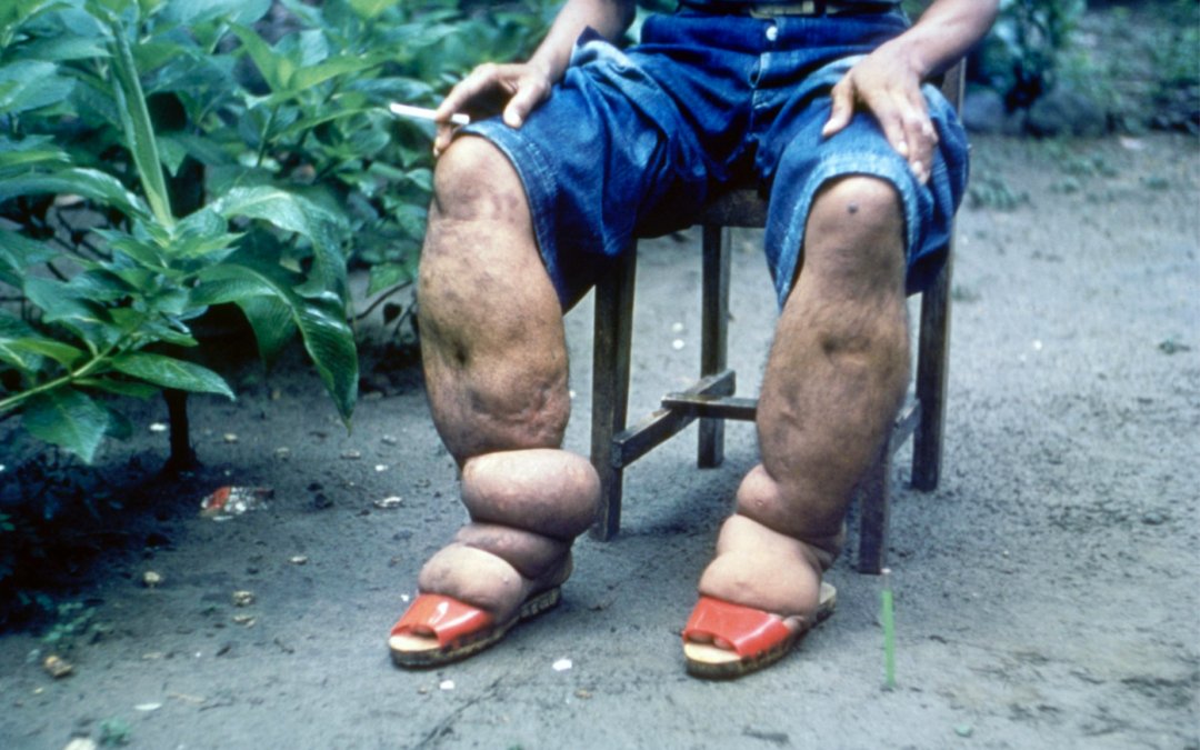 Riset Kolaborasi FKM UNEJ dan BRIN: Status Sosial Bukan Penentu Kaki Gajah, Penggunaan Obat Nyamuk Turunkan Risiko 25%